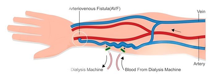 hemodialisis-fistulla