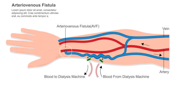 fistula-arteriovenosa-alathemodialisis