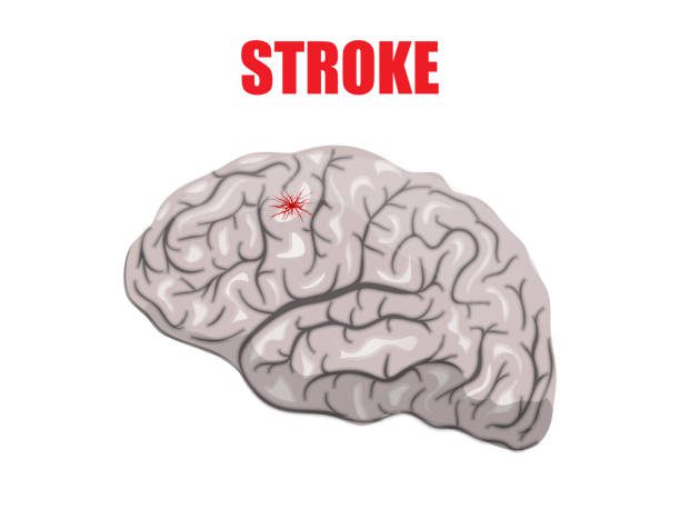 stroke-non-hemoragik