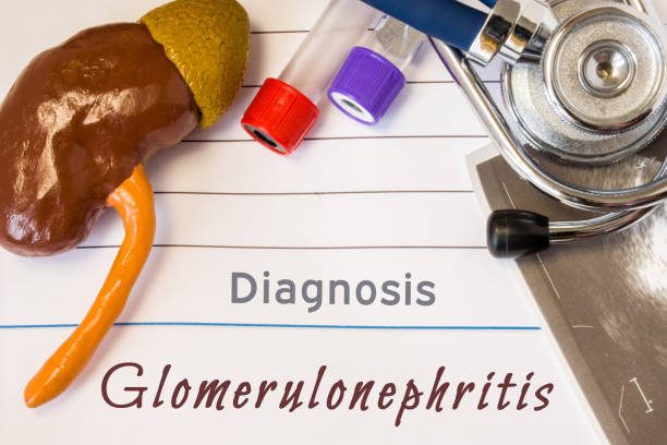 glomerulonefritis-diagnosis