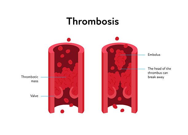 komplikasi-trombosis-arteri