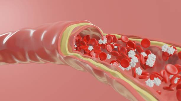 pencegahan-trombosis-arteri.