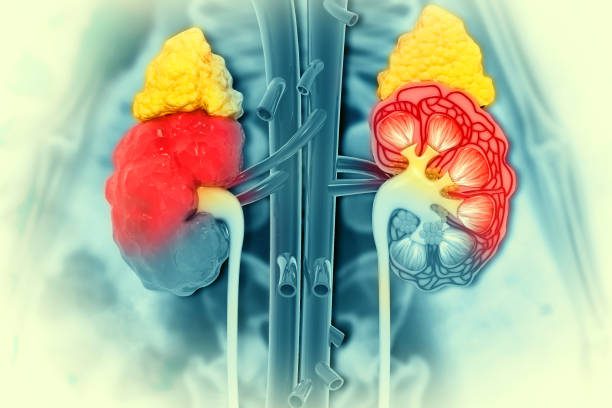 perbedaan-tumor-ginjal
