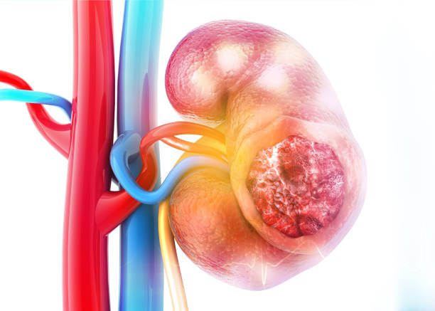 tumor-ginjal-diagnosis